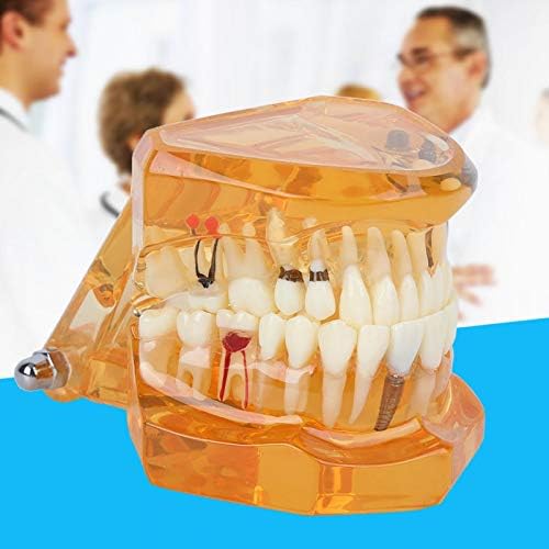 ALREMO HUANGXING - Zubovito obrazovanje, podučavati demontažni model Demo, patološka anatomija narančasta za stomatološke škole Pravne